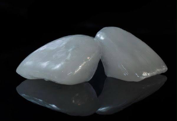 Duas lentes E.max — close lateral